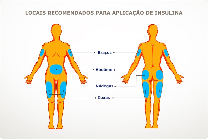 Como aplicar corretamente a insulina? Pratique o RODÍZIO